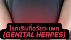 เริมที่อวัยวะเพศ 101