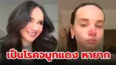 สาวกุมขมับหลังเป็นโรคจมูกแดงหายาก