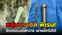 ชายบราซิลไปหาหมอ "หลังเอาดัมเบล" ออกจากก้นไมได้