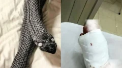 ถุงน่องลายงู VS ข้อเท้าแตก! เรื่องไวรัลที่หลอกทั้งโซเชียล