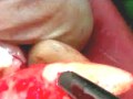 ผ่าฟันคุด (ถ้ากำลังกินข้าวอยู่ห้ามเข้ามาดู) Impacted Canines Surgery