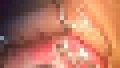 18+ คลิปสยองผ่าตานำดินสอที่ติดอยู่ออกมา ใครใจไม่ถึง อย่าดู !