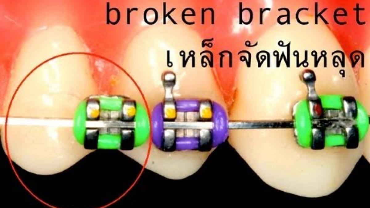 จัด ฟัน เหล็ก Ep.11 การถอดเครื่องมือจัดฟัน (Debond Braces) ข้อมูล