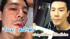 (คลิป) โดม ปกรณ์ ลัม อยู่ในช่วงหน้าพังหนักมาก ล่าสุดโชว์หน้าสดพร้อมเผยใช้สิ่งๆ นี้รักษาหน้า
