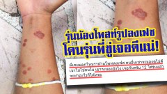 รับน้องต้องซาดิสม์? รุ่นพี่รับน้องโหด หยดเทียนใส่แขน พอรุ่นน้องโพสท์ลงเฟซ โดนรุ่นพี่ขู่เจอดีแน่!