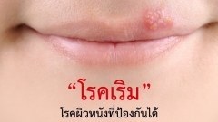 “โรคเริม” โรคผิวหนังที่ป้องกันได้
