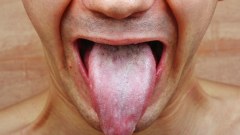 "ลิ้น" บอกโรคทำนายสุขภาพ "ลิ้นเป็นฝ้า" สัญญาณเสี่ยง "ป่วยติดเชื้อ HIV"