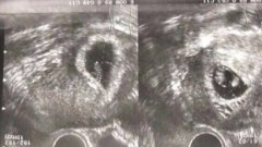 หายาก! คุณแม่วัย 39 ผ่าคลอดลูกแฝด มีมดลูก 2อันเชื่อมกันเป็นรูปหัวใจ