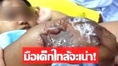 พ่อสุดซ้ำ! โรงพยาบาลดัง สุดชุ่ย ทำมือลูก 1 ขวบบวมเป่ง 3 วัน ยังไร้คนรับผิดชอบ