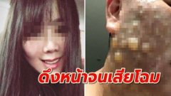 ศัลยกรรมทำพิษ หญิงสาวไปดึงหน้าเสริมสวย กลับเสียโฉมหน้าพุพองเป็นหนอง สุดสยอง