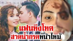 หนุ่มอดีตดับเพลิง หึงโหด สาดน้ำกรดใส่หน้าสาวคนรัก จนหน้าใบหน้าเสียโฉม