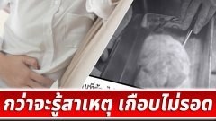 สาวท้องป่องเหมือนครรภ์ 4 เดือน แต่ประจำเดือนมามาก ไปหาหมอถึงรู้ความจริง