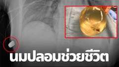 นมปลอมช่วยชีวิต หมอเผยซิลิโคนกันกระสุน คนไข้หญิงรอดตาย