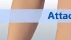 การผ่าตัดเปลี่ยนอวัยวะเพศชายทั้งพวงครั้งแรกของโลก