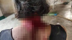 สยอง ยายถูกสุนัขสิบตัวรุมกัดที่เพชรบูรณ์ แผลเหวอะหว่ะทั่วร่าง