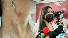 พริตตี้สาว เจ็บหนัก เข้าแจ้งจับอดีตแฟนหนุ่ม หลังถูกทำร้าย-บีบคอ ปมหึงหวง