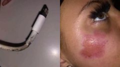 สาววัย 17 ปี ถูกไฟไหม้หน้า หลังชาร์จ ไอโฟน บนที่นอนและเล่นไปด้วย