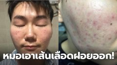 หนุ่มเล่าอุทาหรณ์ หน้าพัง ชีวิตพังเป็นเดือน เพราะเชื่อหมอ!!