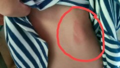 ครูโหดตบหน้า ตีเด็ก เพราะทำการบ้านผิด โกหกว่าเด็กลื่นล้ม