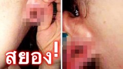 สุดช็อค!สาวขอความเห็นใจ โชว์รูหูหมดสภาพ จากการโดนแฟนทำพิเรนทร์
