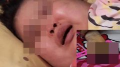 สุดสลด!! "น้องนิว" ป่วยโรคนิ้วมือเท้าไหม้ดำ ต้องถูกตัดมือข้างซ้าย
