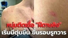 ชายวัย 31 ติดเชื้อ "ฝีดาษลิง" เริ่มมีตุ่มขึ้น ขึ้นรอบรูทวาร