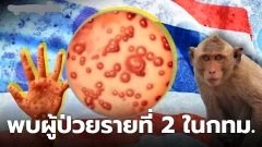 "อนุทิน" เผย กรมควบคุมโรค พบผู้ป่วย "ฝีดาษลิง"คนที่ 2 เจอในพื้นที่กรุงเทพฯ เป็นชายไทย สปคม.เร่งสอบสวนโรค