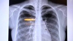 นมจริงนะ! นางแบบสาวชาวญี่ปุ่น "ฟูมินะ ซูซูกิ" ยันภาพหน้าจอ X-ray หลังถูกนินทาว่า หน้าอกของเธอไม่ใช่ของแท้