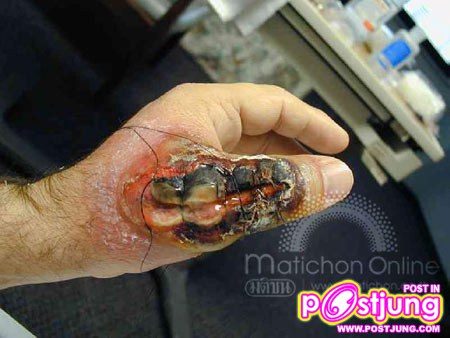 แผลเกิดจากการกัด