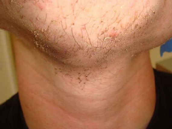 OMG !!! โกนหนวดด้วยไฟแช็ค