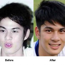 หนุ่มตี๋หล่อ Before & After