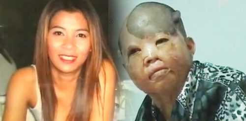 หัวใจที่แข็งแกร่งของ จิ๊บ รัตนา เหยื่อซานติก้าผับ กับร่างที่ไม่เหลือเค้าเดิม