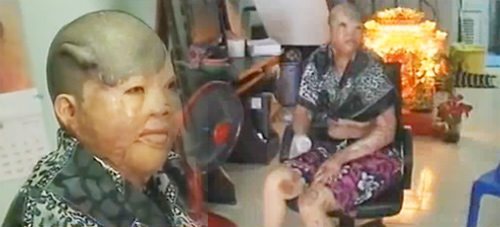 หัวใจที่แข็งแกร่งของ จิ๊บ รัตนา เหยื่อซานติก้าผับ กับร่างที่ไม่เหลือเค้าเดิม