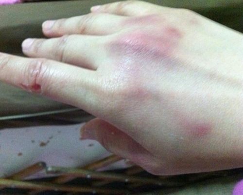 ต่าย สายธาร โพสต์ภาพถูกแฟนซ้อม ว่อนเน็ต