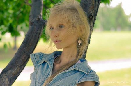 เผยภาพ สาวรัสเซีย น้ำหนักเพียง 20 กิโลกรัม