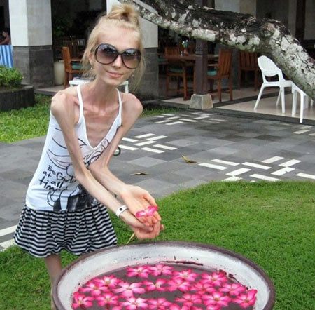 เผยภาพ สาวรัสเซีย น้ำหนักเพียง 20 กิโลกรัม