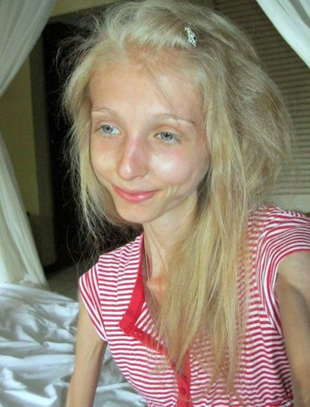 เผยภาพ สาวรัสเซีย น้ำหนักเพียง 20 กิโลกรัม