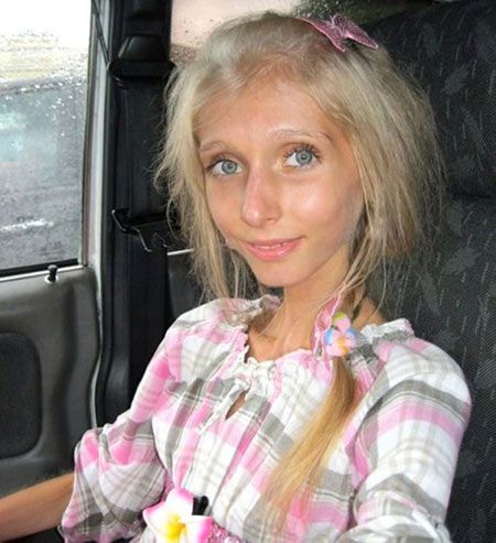 เผยภาพ สาวรัสเซีย น้ำหนักเพียง 20 กิโลกรัม