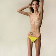 โรคคลั่งผอม Anorexia