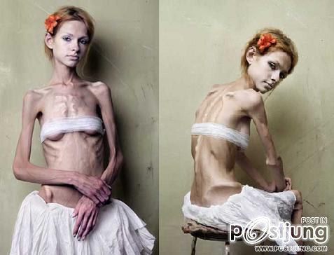 โรคคลั่งผอม Anorexia