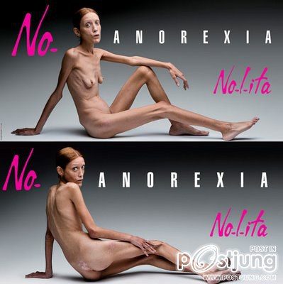 โรคคลั่งผอม Anorexia