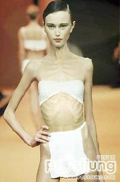 โรคคลั่งผอม Anorexia