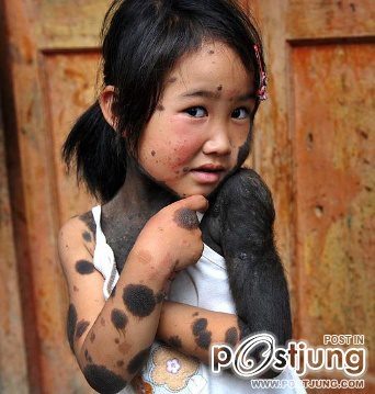 หนูน้อยคนนี้อาศัยอยู่ในจีน  เธอถูกพ่อเเม่รังเกียจเพราะเป็นโรคประหลาด