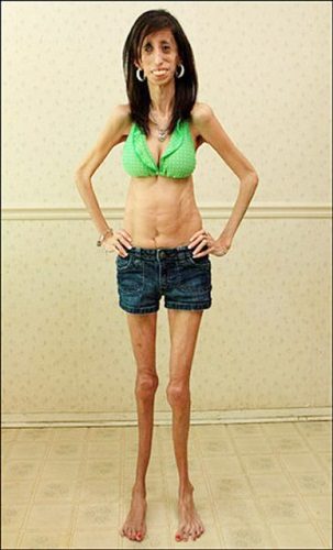 สาวป่วยแปลก! ต้องกินอาหารทุก 15 นาที เพื่อไม่ให้ตาย