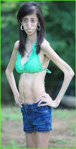 สาวป่วยแปลก! ต้องกินอาหารทุก 15 นาที เพื่อไม่ให้ตาย