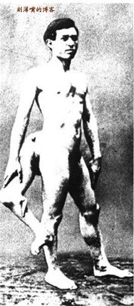 คนสามขา โดยเขาเกิดมามี 3 ขา