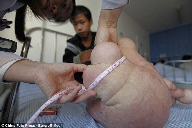 เด็กจีนเท้าโต เด็กฮอบบิท โรคเท้าประหลาด น่าสงสารสุดๆ
