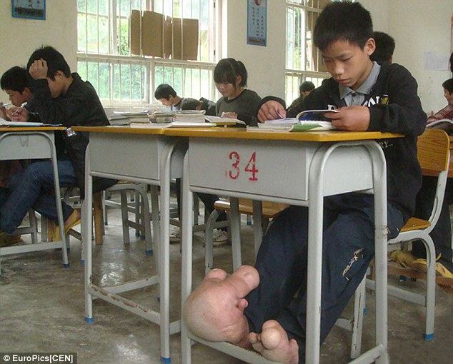 เด็กจีนเท้าโต เด็กฮอบบิท โรคเท้าประหลาด น่าสงสารสุดๆ