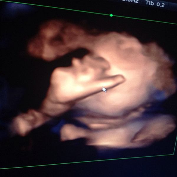 ชมกันชัด ๆ ภาพอัลตราซาวด์ หน้าลูกชาย ป๋อ ณัฐวุฒิ - เอ๋ พรทิพย์