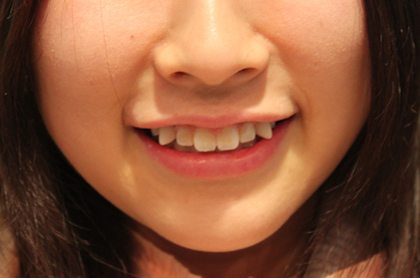 สึเคะ-ยาเอบะ เทรนด์ต่อฟันเขี้ยวที่มาแรงสุด ๆ ในญี่ปุ่น